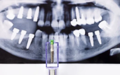 Impianto dentale: tutto quello che devi sapere prima di prendere una decisione