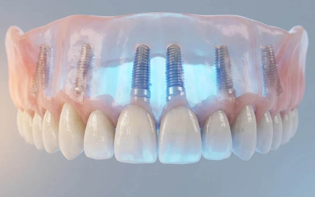 Full Arch su impianti: la soluzione definitiva per chi ha perso tutti i denti