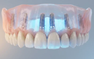 Full Arch su impianti: la soluzione definitiva per chi ha perso tutti i denti